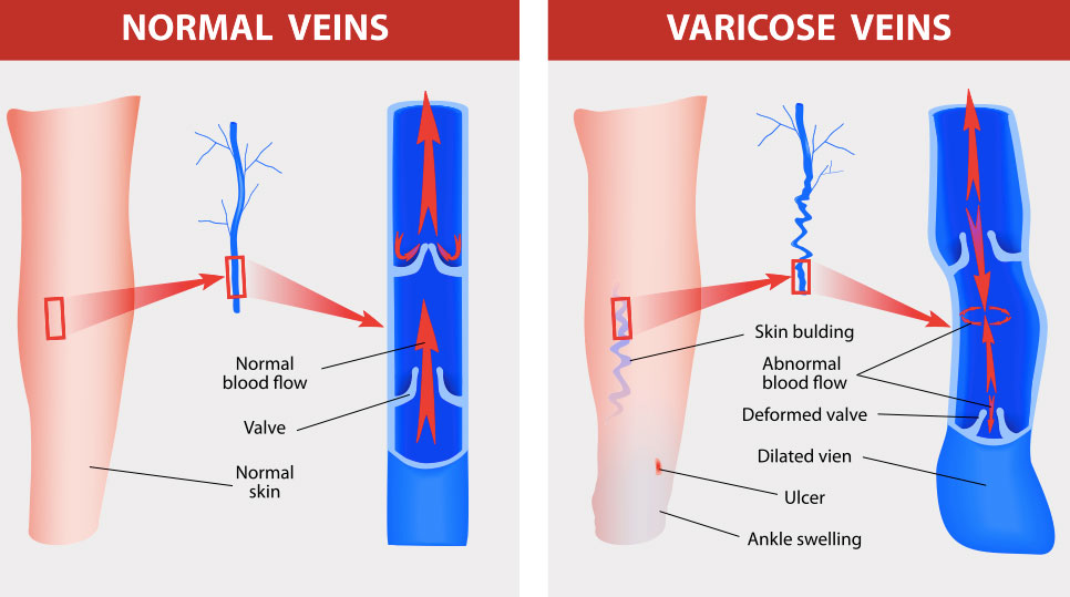 varicose-veins